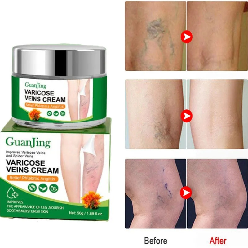 Crema para aliviar las venas varices